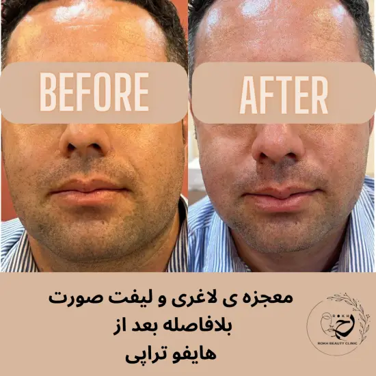 لاغری صورت بلافاصله پس از اتمام هایفوتراپی ردشت کرج
