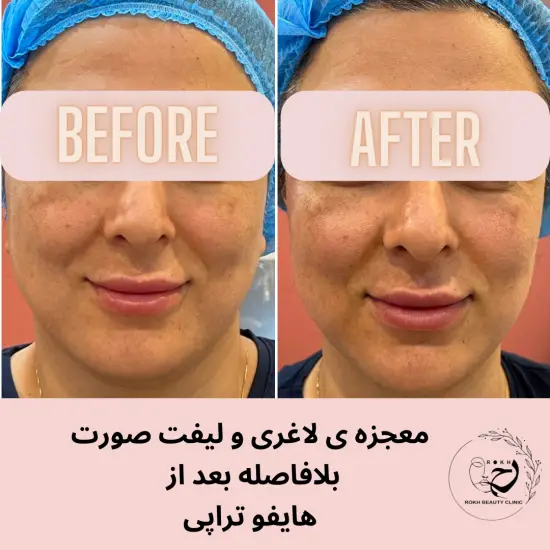 لاغری صورت بلافاصه پس از اتمام هایفوتراپی 