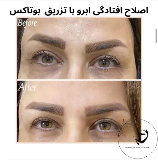 اصلاح افتادگی ابرو با تزریق بوتاکس 